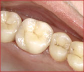 Mit Cercon smart ceramics gefertigter Zahnersatz ist kaum von Ihren gesunden Zähnen zu unterscheiden